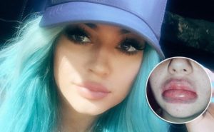 Kylie Jenner cosmetic surgery